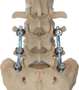 Lumbar Fusion Benjamin Ditty Md 